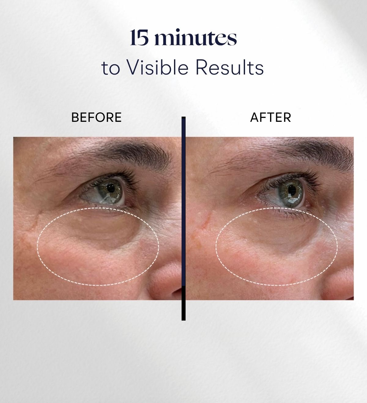 Before and after using Intuisse Active NAD+ Collagen Eye Masks for 15 minutes, showing visible under-eye results.